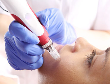 Microneedling